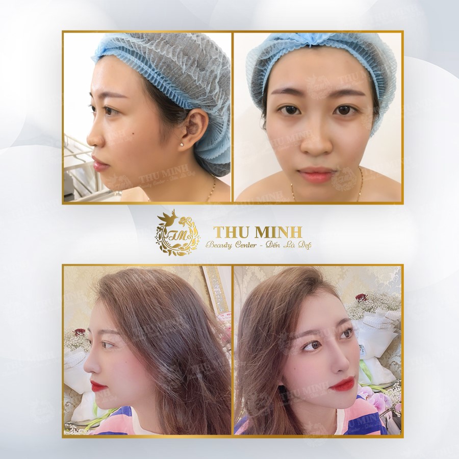 nâng chân mũi xệ